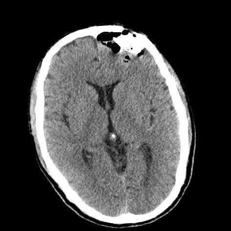 Vỡ lún xương sọ, suýt mất mạng chỉ vì quên đội mũ bảo hộ