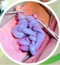 'Tết tóc' bằng dây rốn trong bụng mẹ và cuộc giải cứu kịp thời ở tuần 30