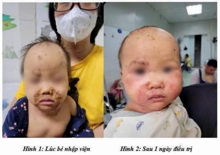 Bé 10 tháng viêm kết mạc nặng sau 1 ngày gia đình tự nhỏ thuốc