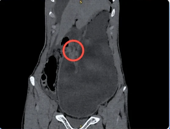 Chàng trai 17 tuổi thủng ổ loét môn vị tá tràng nguy kịch vì thức khuya