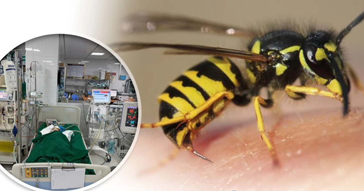 Bé gái 9 tuổi ở Nghệ An nguy kịch vì ong vò vẽ đốt dày đặc