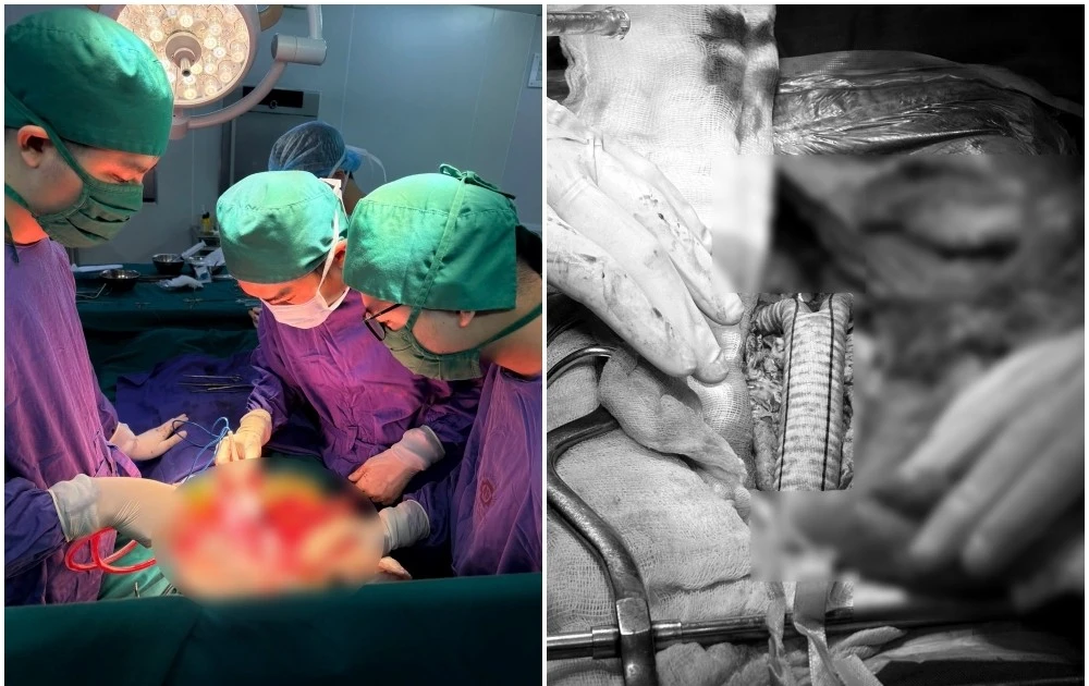 Một lần mổ thay cả động mạch chủ chậu, lấy sỏi ống mật chủ ở người ung thư