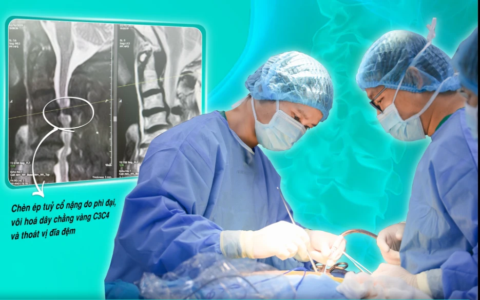 Giải ép tủy sống cho cụ bà 82 tuổi bị hẹp ống sống cổ nặng