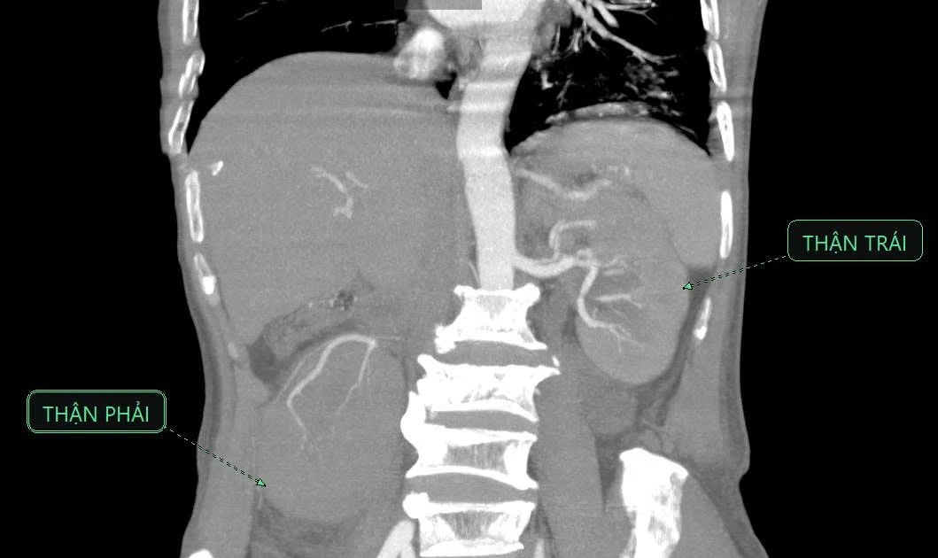 Cứu người bệnh xơ gan viêm thận bể thận nguy kịch