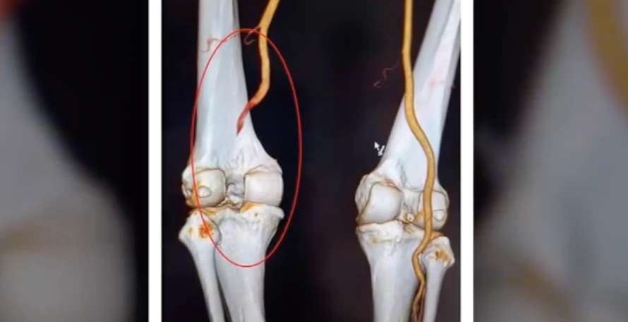 Giữ chân cho bệnh nhân Phú Thọ bị đứt mạch máu khoeo
