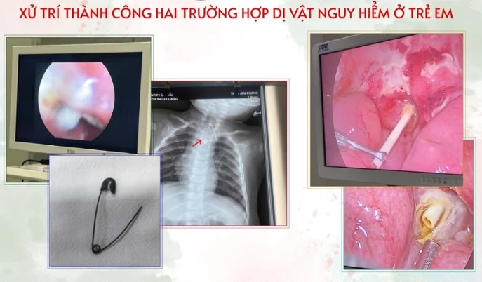 Thích ăn kẹo mút, trẻ viêm phúc mạc nặng vì que kẹo đâm thủng tá tràng