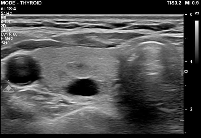Bác sĩ chỉ rõ dấu hiệu, cách theo dõi nang tuyến giáp an toàn