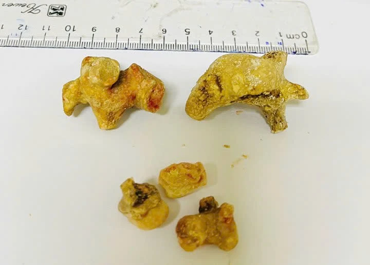 Đau quặn bụng người phụ nữ bị sỏi san hô lớn gây giãn đài bể thận