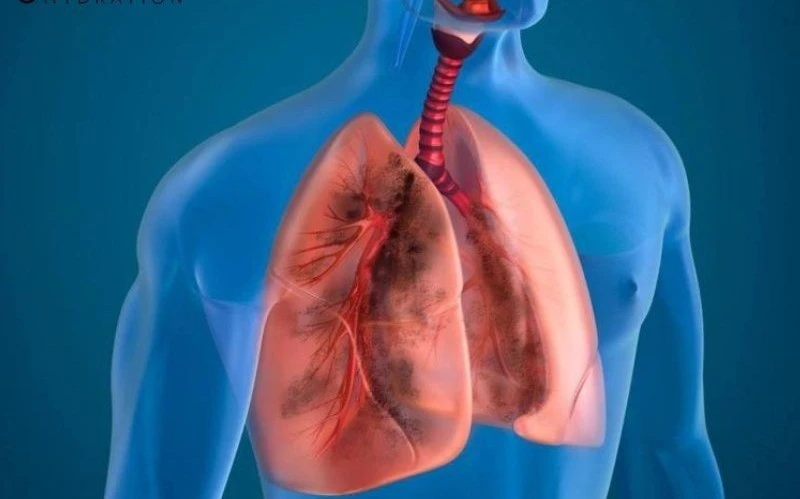 Bệnh phổi tắc nghẽn mạn tính, nguy cơ gia tăng trong mùa đông lạnh