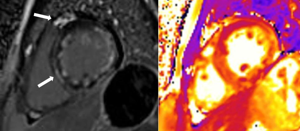 Hồi sinh bệnh nhân trẻ bị ngưng tim do viêm cơ tim cấp