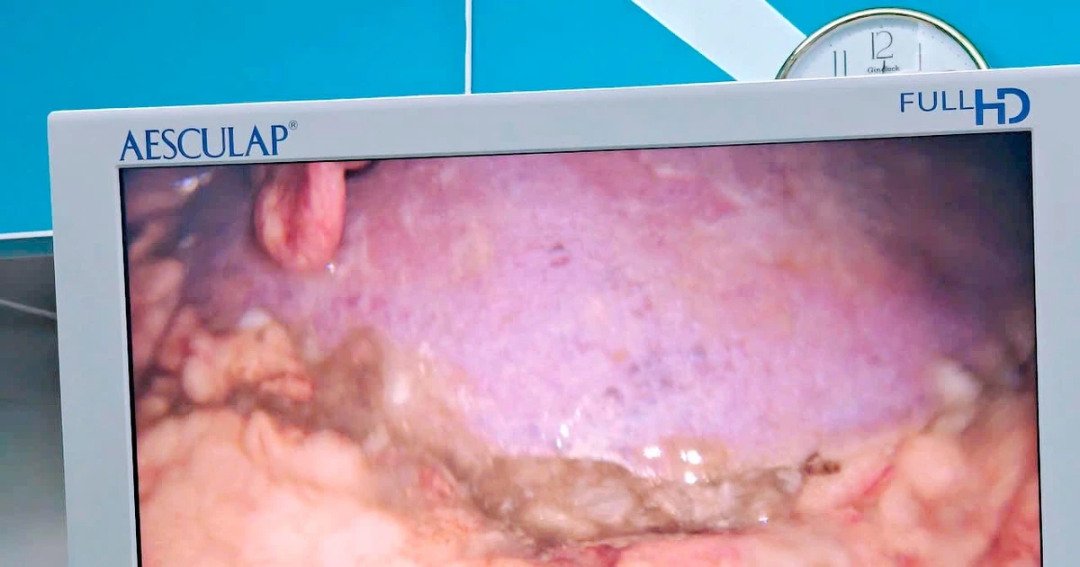 Cứu sống bệnh nhân thủng dạ dày do tự ý dùng thuốc giảm đau