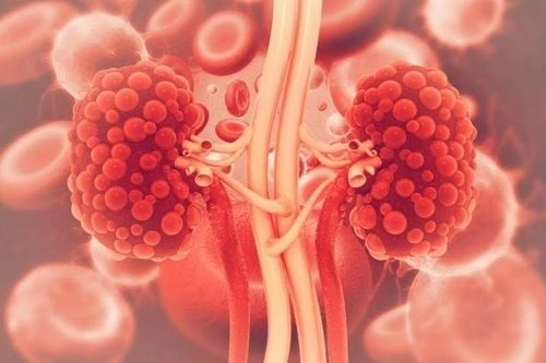 Phẫu thuật kịp thời giúp bệnh nhân thoát khỏi suy thận cấp do sỏi niệu quản