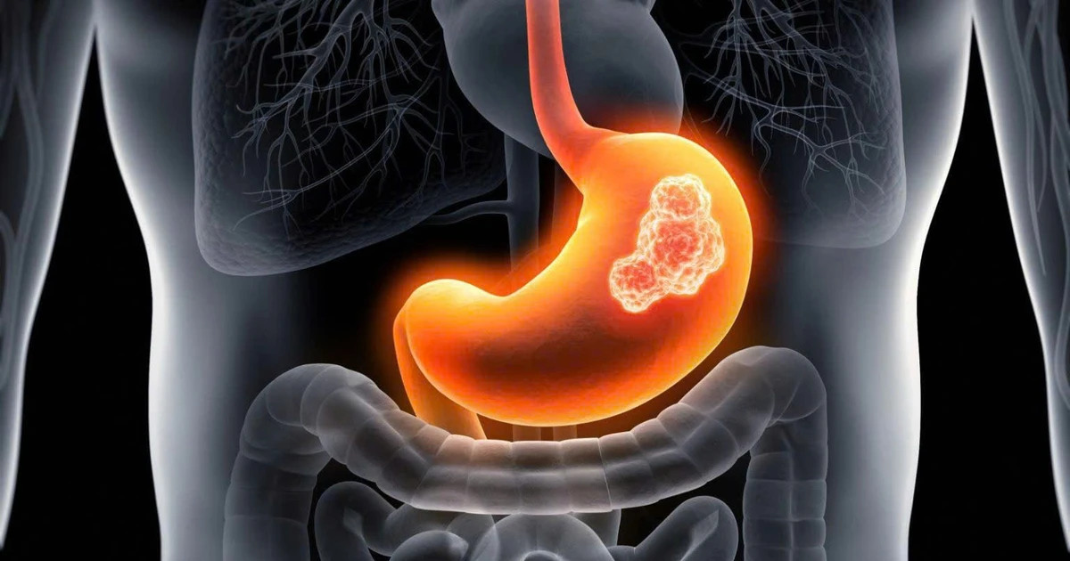 Cách nhận biết sớm ung thư dạ dày qua những dấu hiệu nhỏ