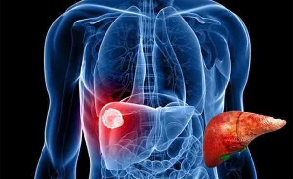 Nguy cơ ung thư gan từ thực phẩm giảm cân trôi nổi