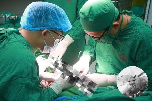 Bảo tồn thành công bàn tay bị vỡ, gãy nát phức tạp