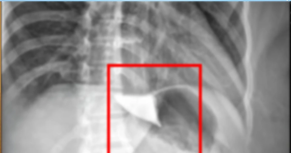 Điều trị thành công ca bệnh co thắt tâm vị không nuốt được