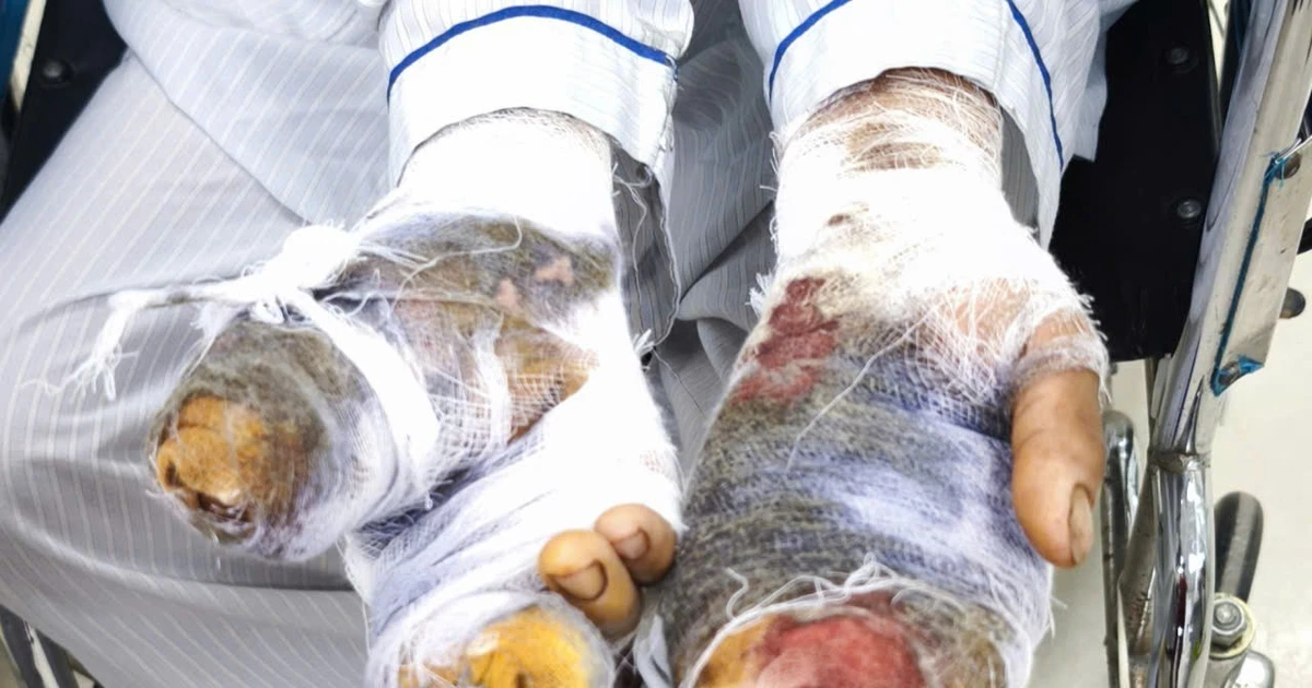 Cụ bà bị chó nhà tấn công cắn nát 2 bàn tay