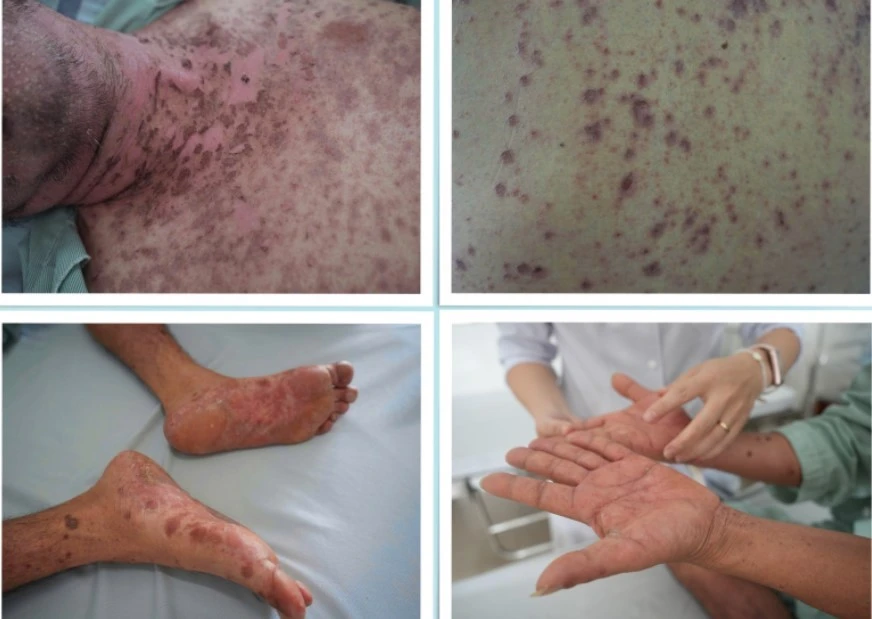 Tự dùng thuốc gút người bệnh dị ứng toàn thân nghiêm trọng