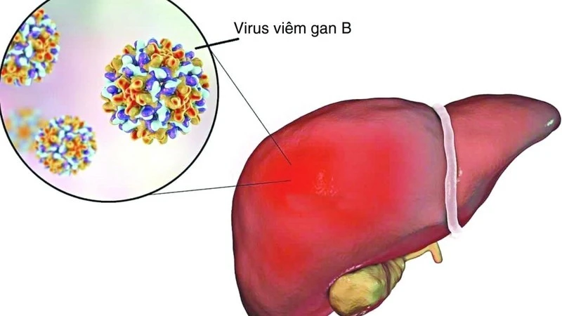 Viêm gan siêu vi B - kẻ giết người thầm lặng