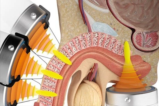 Sóng xung kích điều trị rối loạn cương dương