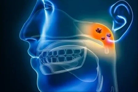 Nguyên nhân âm thầm dẫn đến ung thư vòm họng, cách phòng tránh