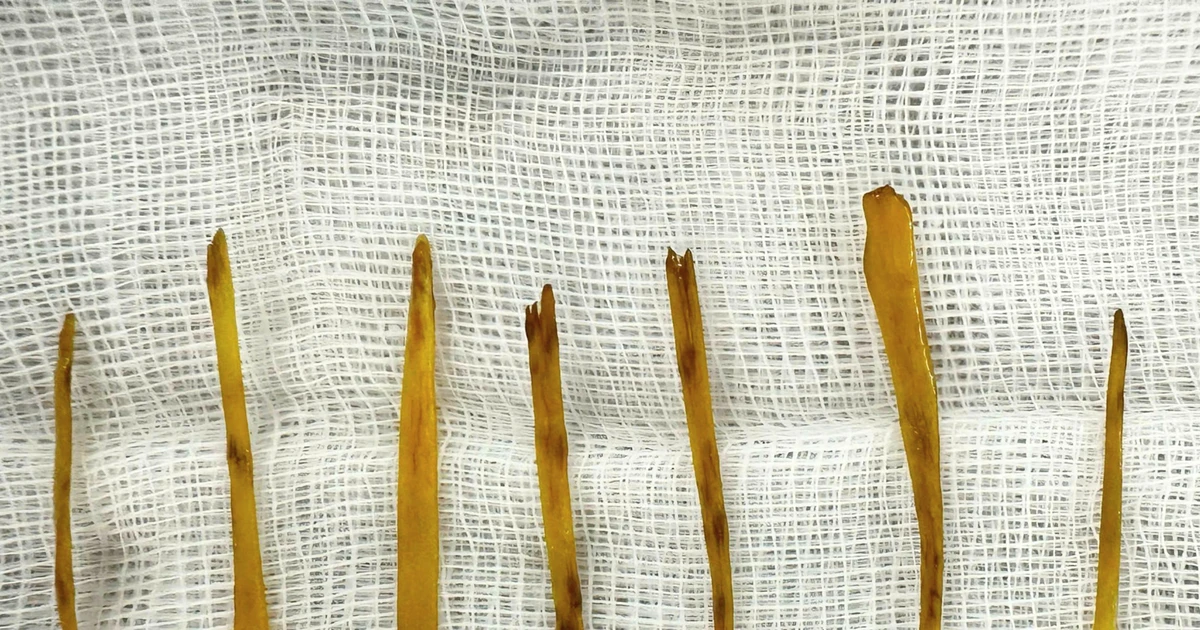 Nuốt xương gà gây thủng ruột, bé gái 13 tuổi cần phẫu thuật khẩn cấp