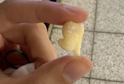 Răng khôn có nhất thiết phải nhổ không?