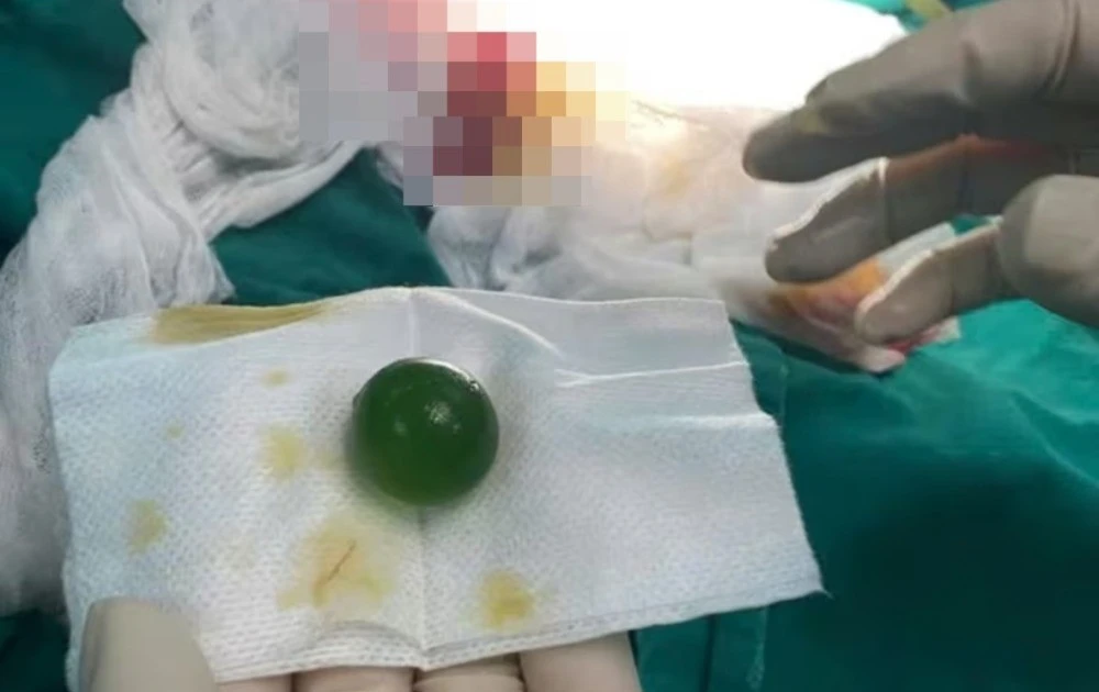 Cứu bé 13 tuổi nuốt phải viên hạt nở lớn tại Lào Cai