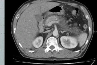 Thay huyết tương cứu sống bệnh nhân viêm tụy nặng do mỡ máu cao