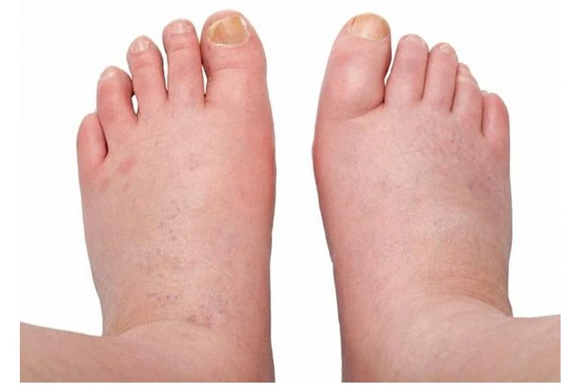 Nhận biết sớm nguy cơ suy thận qua dấu hiệu đi lại, phù chân