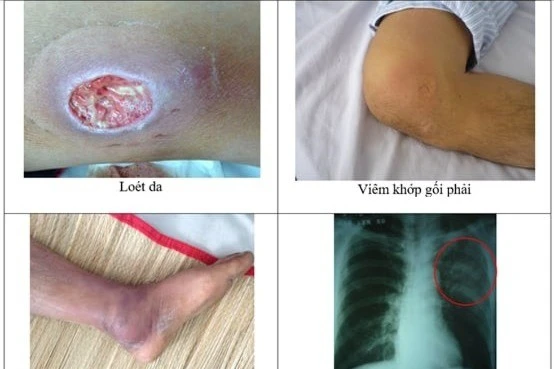 Nhiễm Whitmore, khó chẩn đoán, tử vong cao