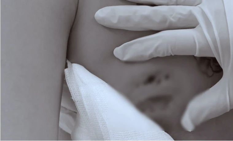 Vòng 1 hoại tử vì tiêm filler nâng ngực