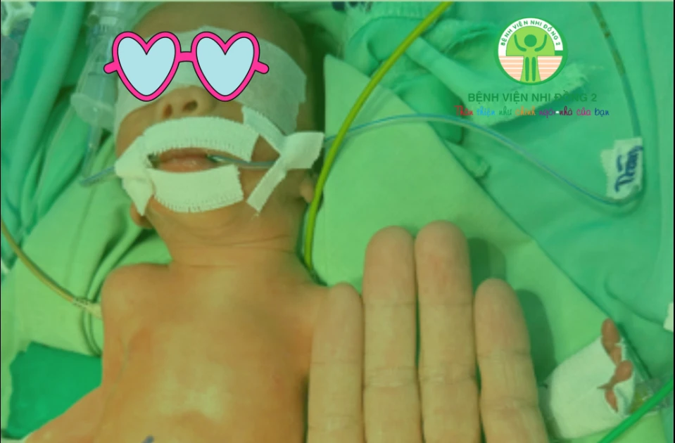 Giành lại sự sống cho trẻ sinh non nặng gần 1 kg bị viêm ruột hoại tử