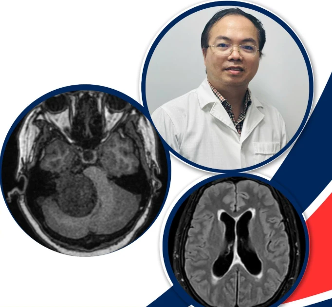 Nhìn mờ, méo miệng, thai phụ sinh con lần 5 phát hiện u não lớn