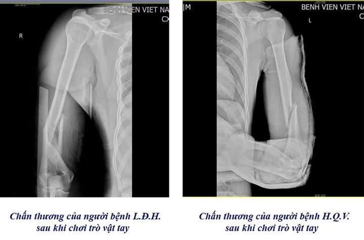 Bác sĩ cảnh báo nhiều ca gãy xương cánh tay khi chơi vật tay