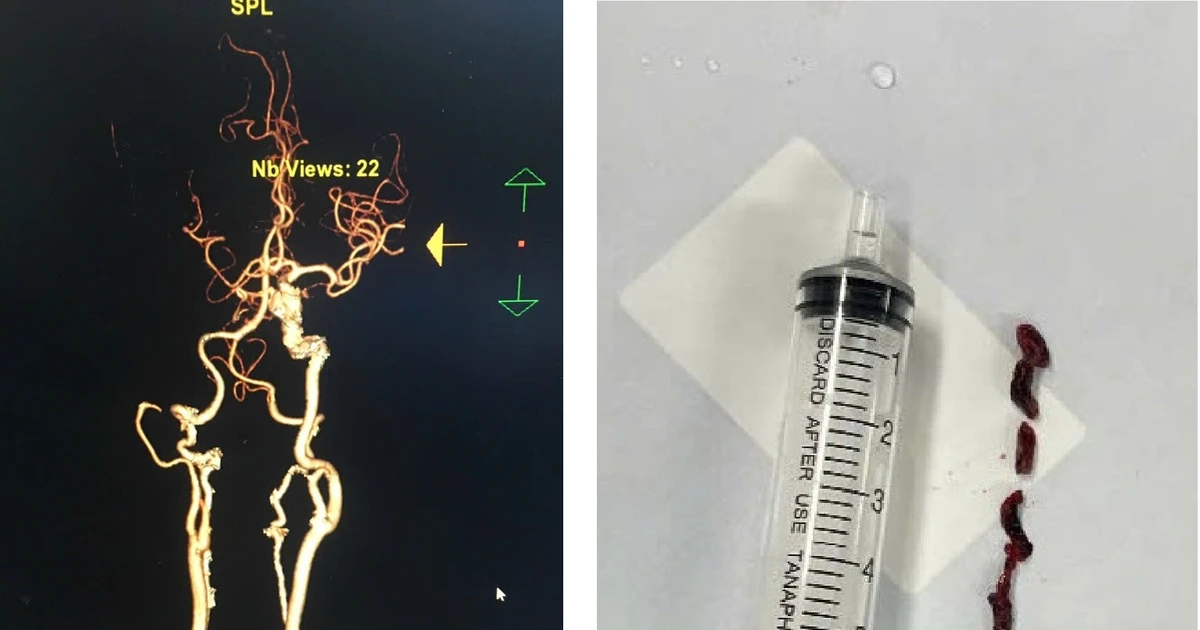 Đi viện điều trị đau bụng, cụ bà 75 tuổi đột quỵ