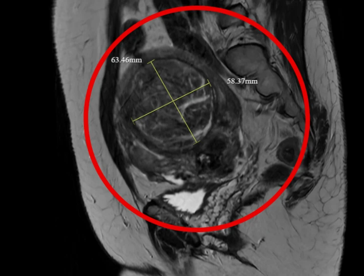 Nút mạch u xơ tử cung to như thai 6 tháng ở người phụ nữ tưởng bệnh mãn kinh