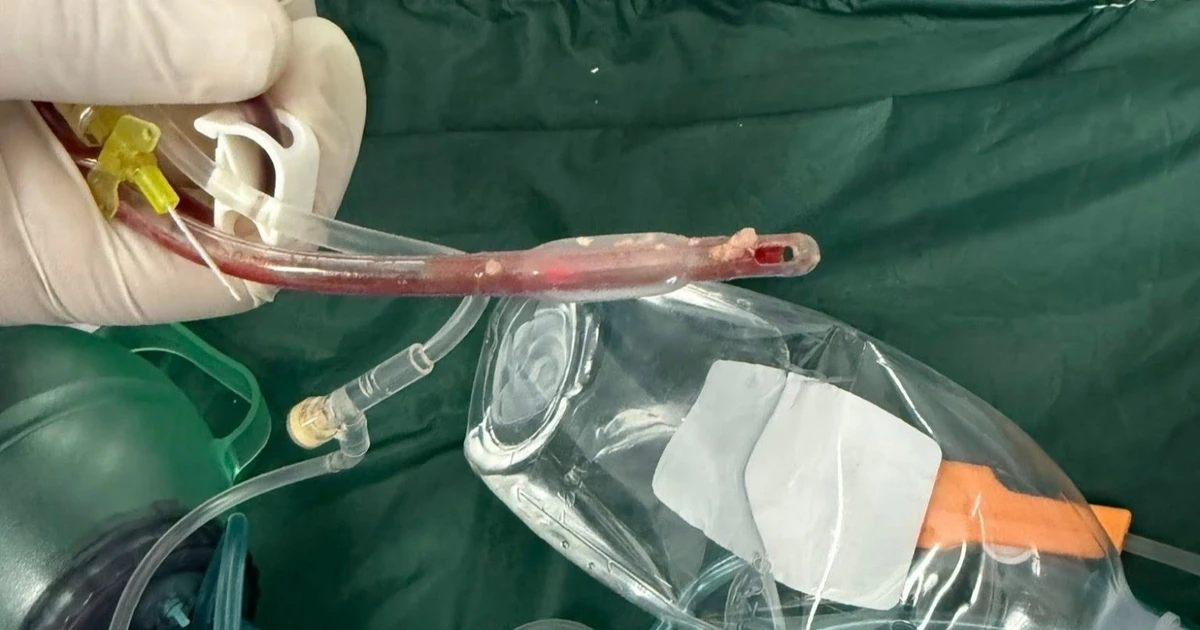 Hồi sức tim phổi 70 phút vẫn không cứu được bé 3 tuổi sặc thức ăn ở lớp