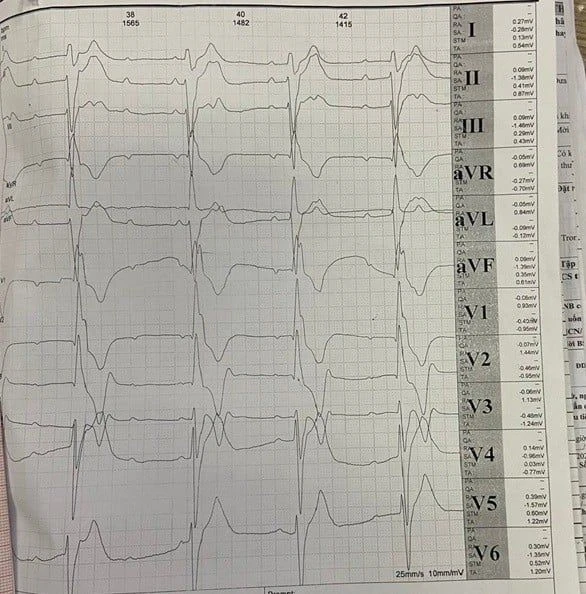 Cao gầy, sụp mí mắt, chàng trai 19 tuổi mắc hội chứng Kearns–Sayre hiếm gặp
