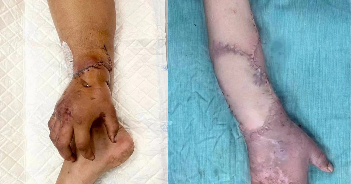 Hành trình kỳ diệu đưa bàn tay nuôi tạm ở cẳng chân trở về vị trí cũ