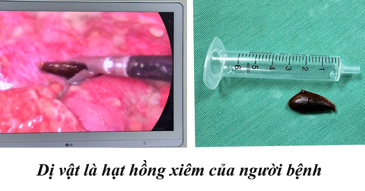 Lấy hóc dị vật xương cá cho trẻ 12 tuổi và hạt hồng xiêm cho cụ ông 85 tuổi