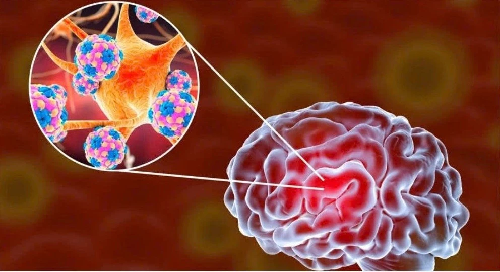 Nguy hiểm của não mô cầu, cách phòng tránh hiệu quả