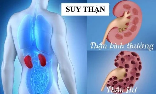 4 sai lầm nguy hiểm khiến bệnh thận tiến triển nhanh hơn