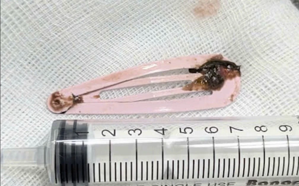 Bé 6 tuổi nuốt kẹp tóc kim loại nguy hiểm được cấp cứu kịp thời