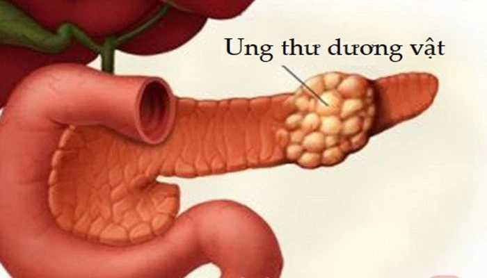 Xu hướng trẻ hóa ung thư dương vật gây lo ngại ở nam giới Việt Nam