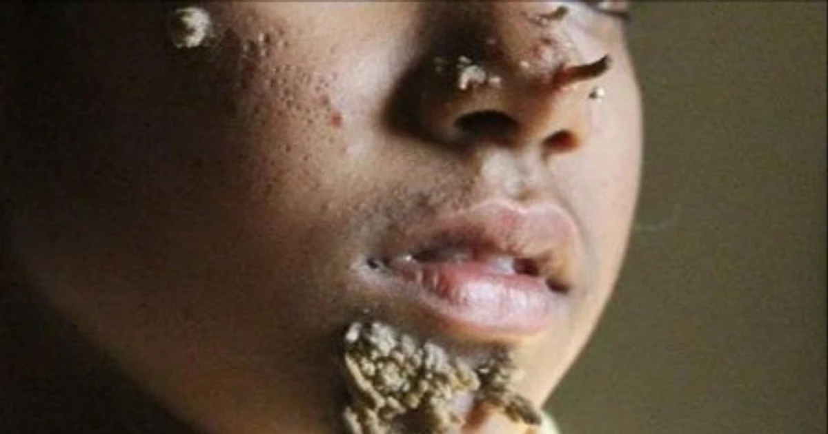 Việt Nam ghi nhận ca thứ hai mắc hội chứng 'người cây', bệnh nguy hiểm sao?