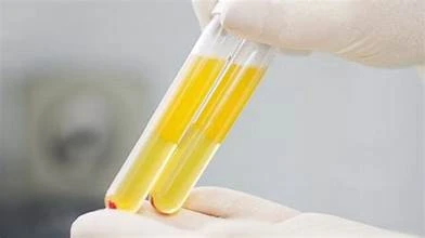 Chữa trị thành công ca viêm tụy cấp do triglycerid cao đột biến