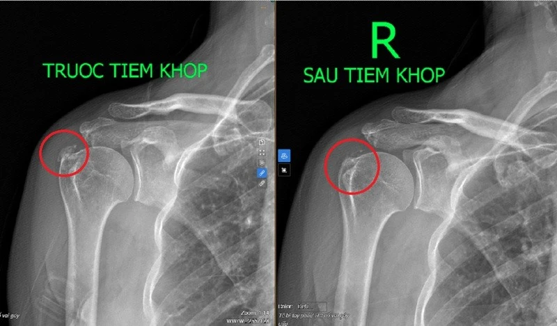 Viêm gân vôi hóa – bệnh lý cơ xương khớp thường gặp ở lứa tuổi trung niên