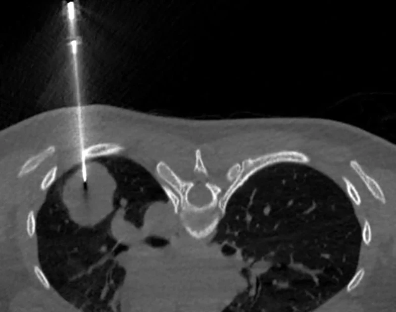 Người phụ nữ trẻ mắc ung thư phổi tế bào nuôi hiếm gặp