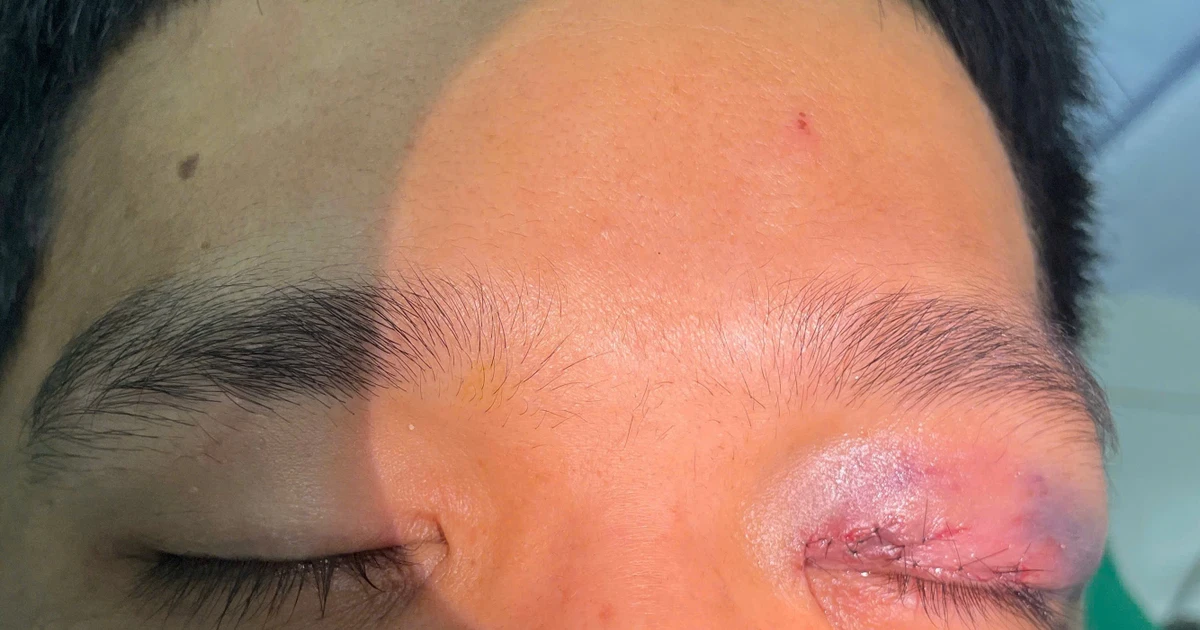 Chấn thương mắt nặng được cứu sống nhờ phẫu thuật kịp thời